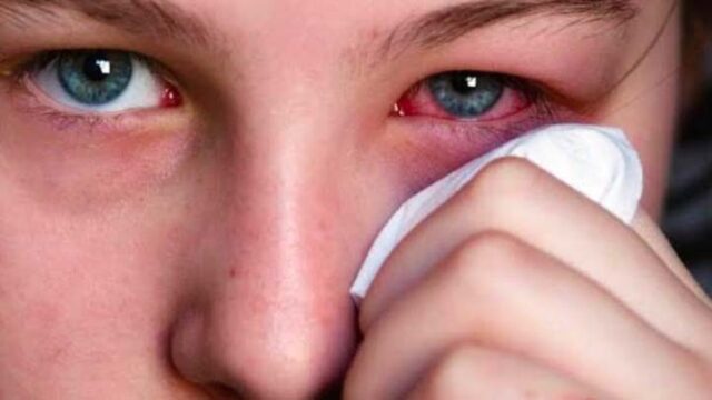 Simak Penyebab Mata Merah dan Ini 7 Tips Gacor Mengatasinya